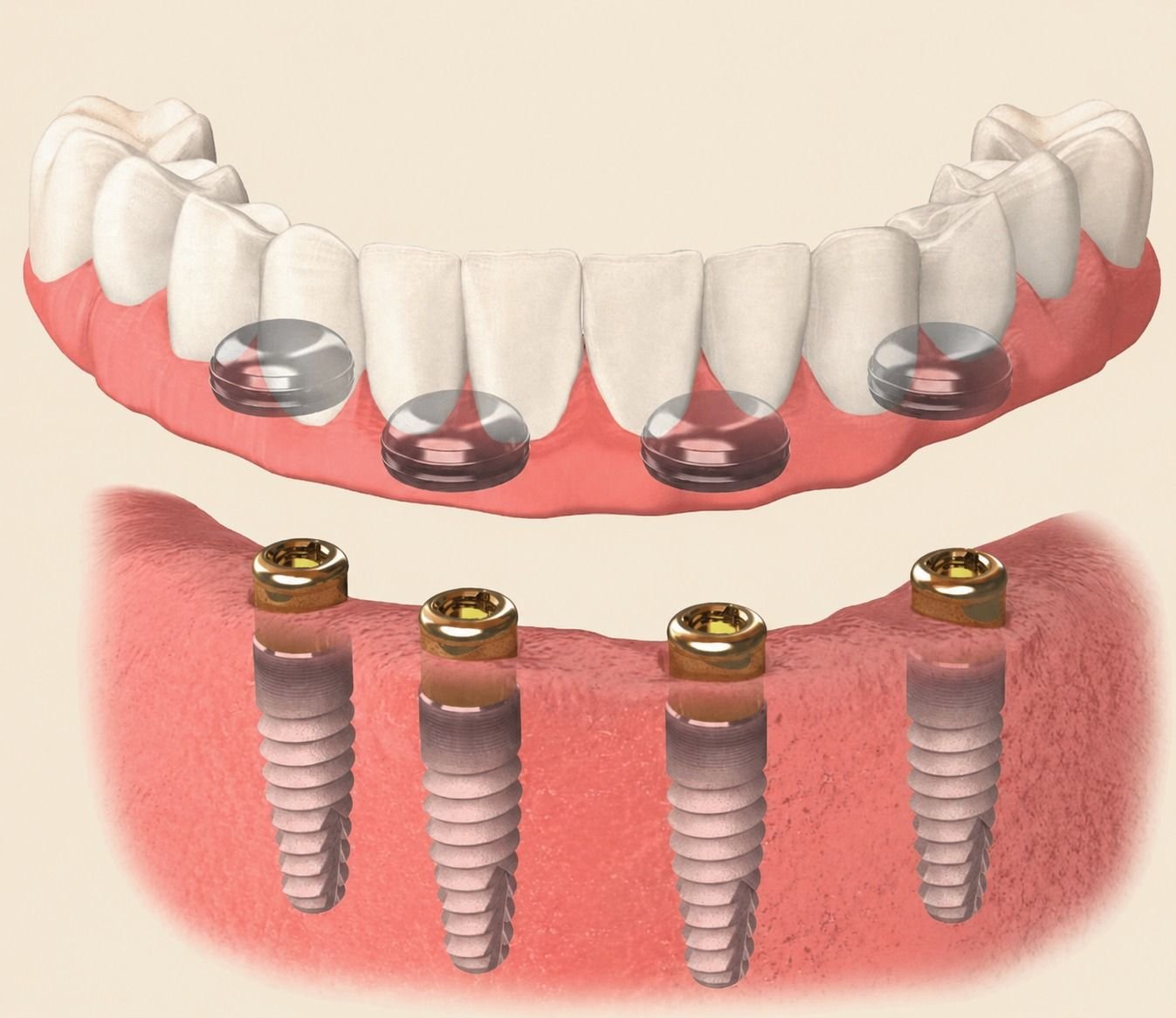 Implant Overdentures in Keller, TX — anatomical illustration