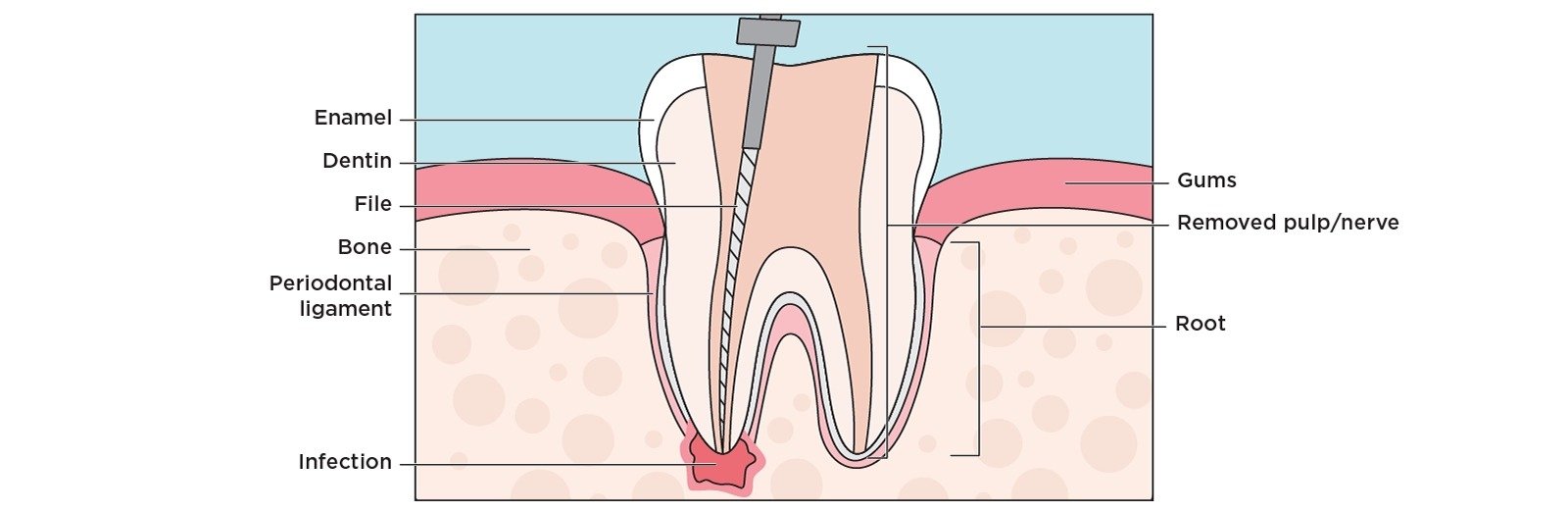 Endodontic Care in Keller, TX — Keller Parkway Dental Keller TX