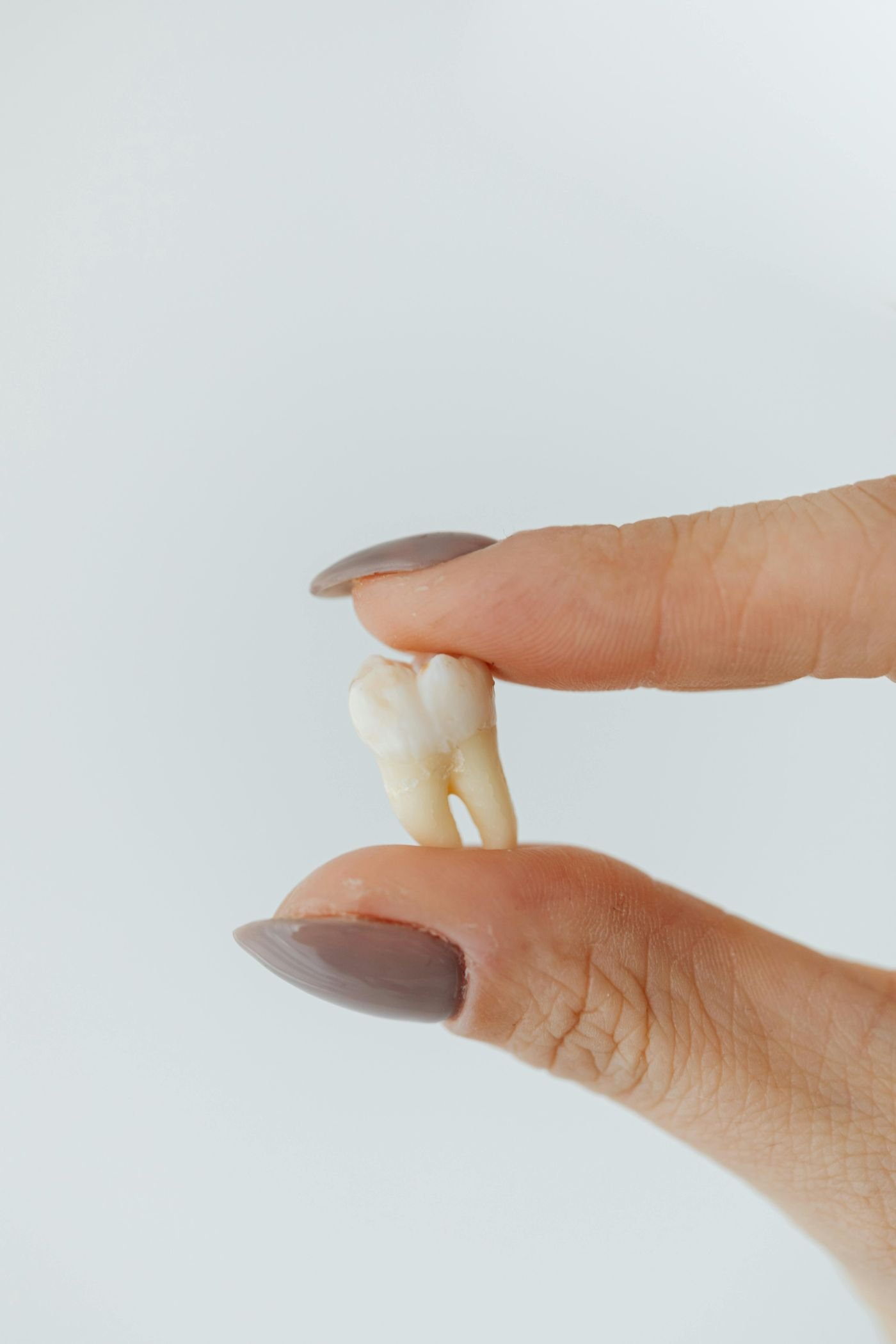 Wisdom Teeth Extractions in Keller, TX — anatomical illustration